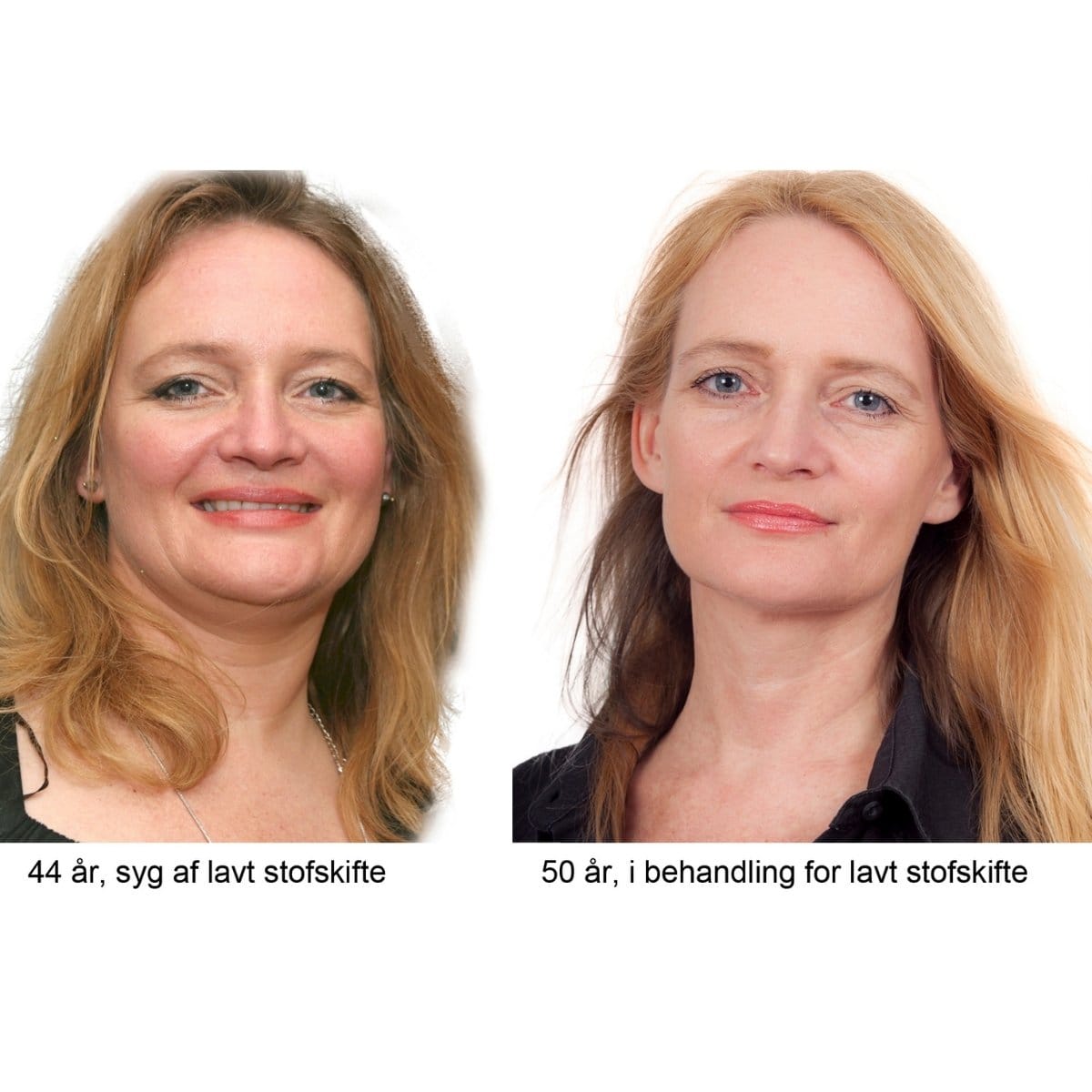 Før og efter billede af forfatter Helle Sydendal ift. behandling af lavt Stoftskifte | Foredrag i FOF Aarhus